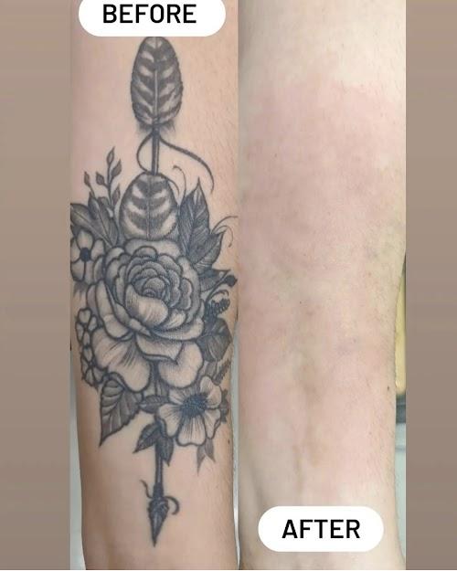 Bonsai Laser Tattoo Removal