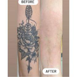 Bonsai Laser Tattoo Removal